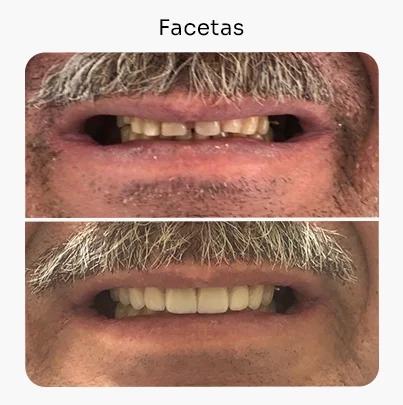 Facetas 2