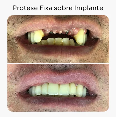 Protese Fixa sobre Implante